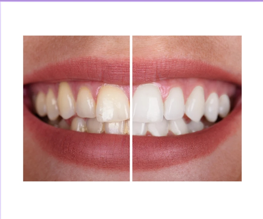 What stains your teeth?